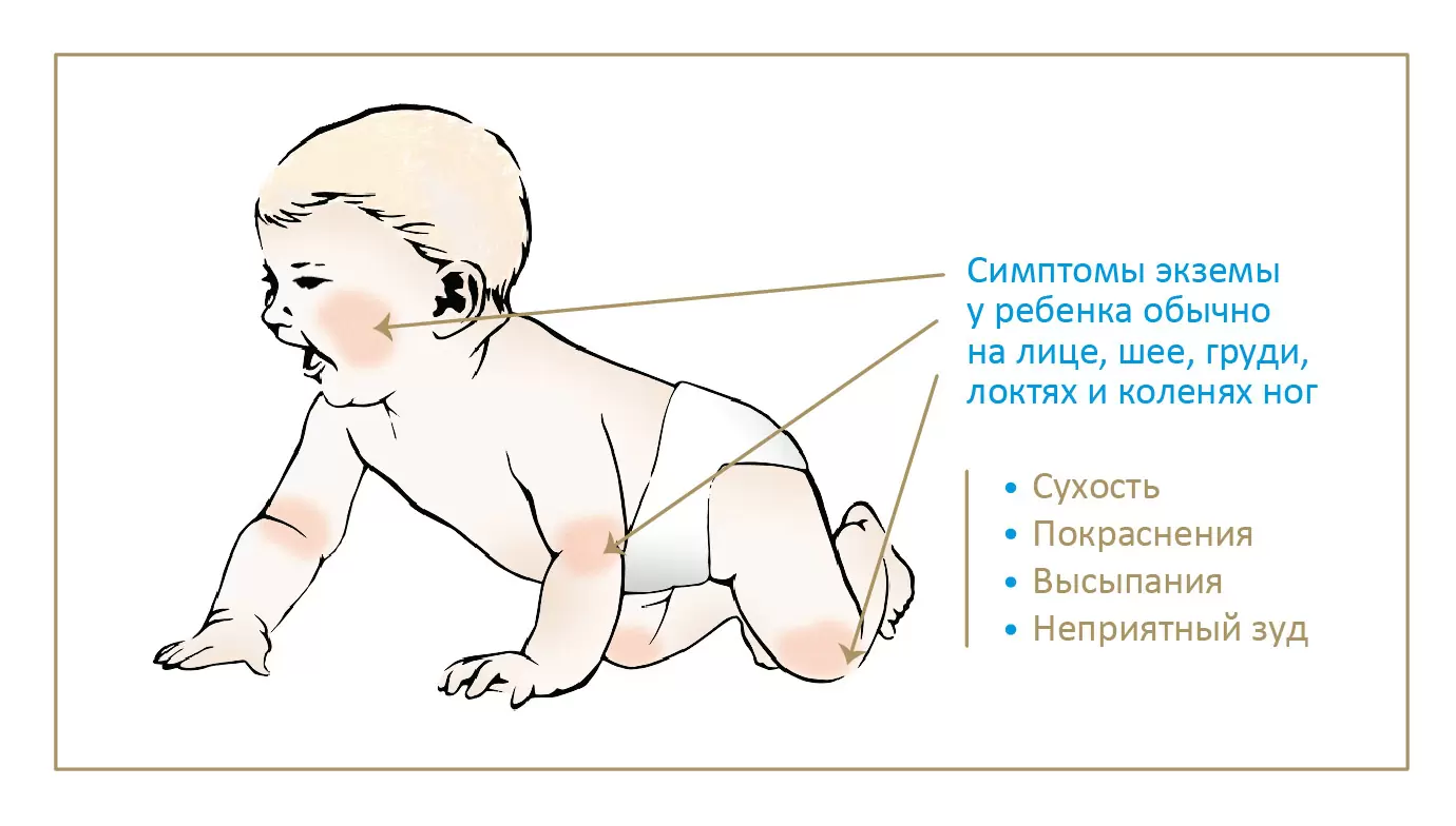 Как отличить симптомы пищевой аллергии у грудничков от признаков других  болезней - Статьи о детском питании от педиатров и экспертов МАМАКО